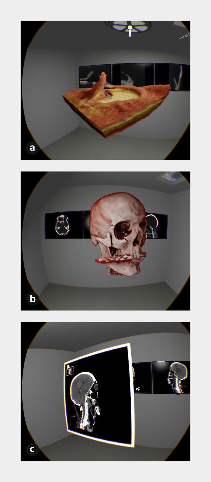 Integration diverser Bilddatenressourcen in die VR, um ihre Leistungsfähigkeit zu zeigen. (a) Import von OCT-Daten eines Netzhaut­risses (gelber Bereich), der unbehandelt zur Blindheit führen kann. (b) VR OCT eines Schädels mit mehreren Brüchen nach einem Skiunfall, (c) VR-Darstellung mit konventioneller Schnittführung bei einem Patienten mit einem Hirntumor, da die VR-Applikation die Originaldaten zeitgleich verfügbar macht.